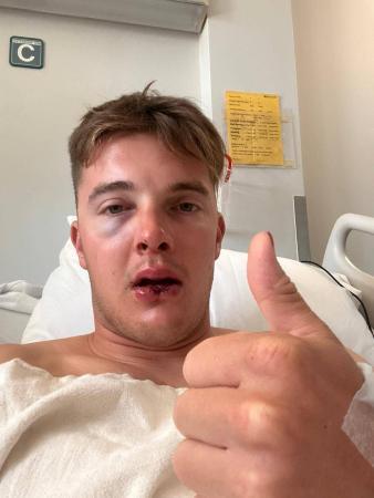 A young man in a hospital bed with a bruised eye and injured lip giving a thumbs-up.