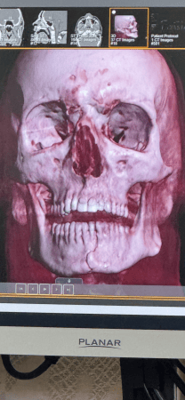 3D CT reconstruction of a human skull displayed on a monitor, showing a fracture in the lower jaw.