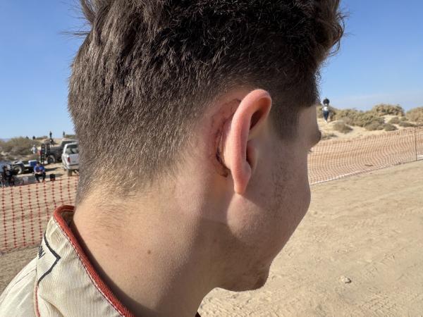 Close-up profile of a person showing a fresh incision mark behind their ear.